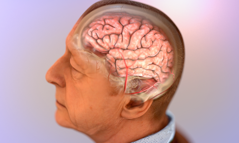 Liệu pháp mới phòng ngừa bệnh Alzheimer