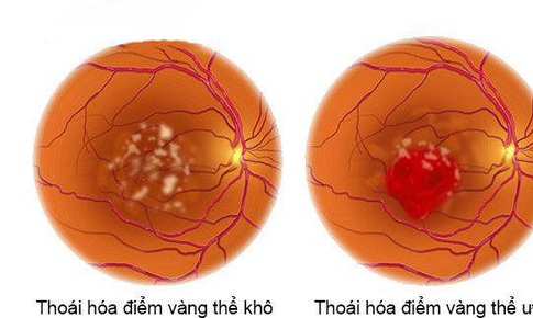 FDA cấp ph&#233;p thuốc sinh học tương tự lucentis trị bệnh tho&#225;i h&#243;a điểm v&#224;ng