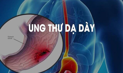 Cách phát hiện sớm ung thư dạ dày
