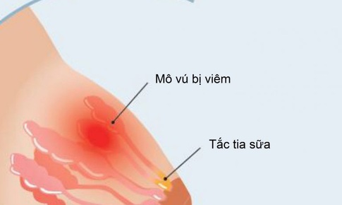 Gi&#250;p mẹ tho&#225;t khỏi nỗi khổ tắc tia sữa