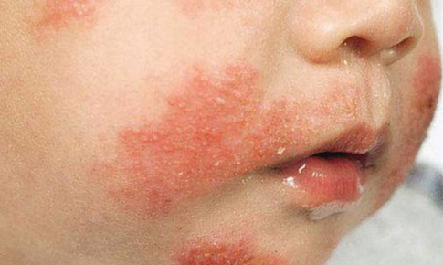 Dị ứng sữa bò ở trẻ em: Triệu chứng và cách xử trí