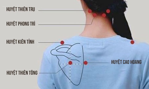 Châm cứu, xoa bóp trị đau vai gáy