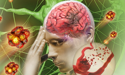 Đột quỵ hiểu đúng để phòng ngừa và điều trị hiệu quả