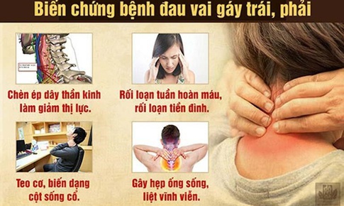 Đau vai g&#225;y l&#224; bệnh g&#236;? Nguy&#234;n nh&#226;n, triệu chứng v&#224; c&#225;ch khắc phục