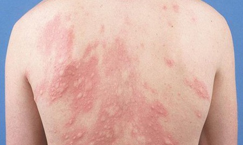 Mề đay l&#224; g&#236;, chữa như thế n&#224;o? 