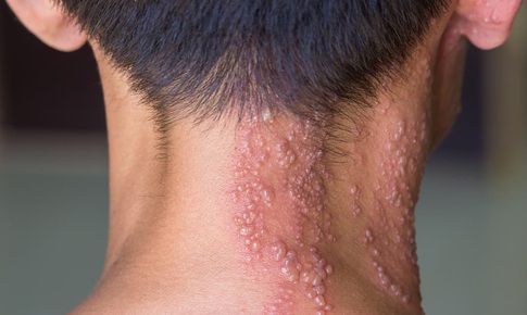 Bệnh zona: Dấu hiệu, triệu chứng và thuốc điều trị