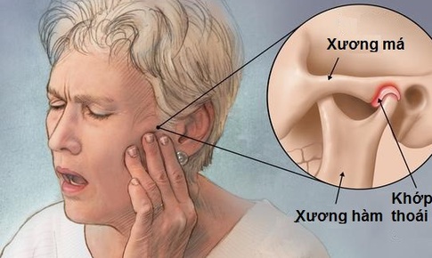 Điều trị vi&#234;m khớp th&#225;i dương h&#224;m 