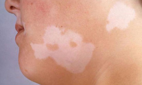 Kem bôi giúp phục hồi sắc tố da ở người bệnh bạch biến