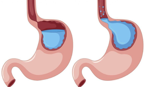 Giải ph&#225;p hỗ trợ d&#224;nh cho người tr&#224;o ngược dạ d&#224;y thực quản