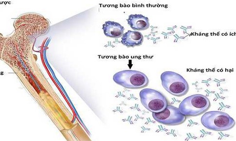 Th&#234;m liệu ph&#225;p điều trị đa u tủy xương t&#225;i ph&#225;t kh&#243; chữa