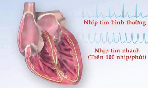 B&#224;i thuốc hỗ trợ trị loạn nhịp tim do t&#226;m huyết hư