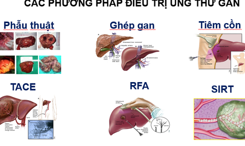 Điều trị v&#224; dự ph&#242;ng ung thư biểu m&#244; tế b&#224;o gan