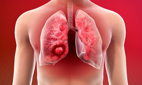 Ung thư phổi - những điều cần biết