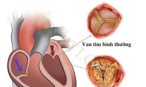 V&#244;i h&#243;a van tim c&#243; nguy hiểm?