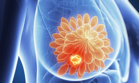 Triển vọng về loại vaccine ung thư vú thử nghiệm có kết quả tốt trên người giai đoạn 1