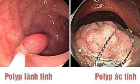 Khi n&#224;o polyp đại&#160;trực&#160;tr&#224;ng th&#224;nh &#225;c t&#237;nh?