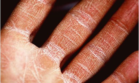 Liệu pháp mới điều trị bệnh viêm da dị ứng