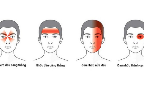 Migraine – bệnh đau nửa đầu gây khó chịu và cách khắc phục