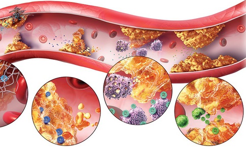Rối loạn lipid máu - Nguyên nhân của nhiều bệnh lý nguy hiểm