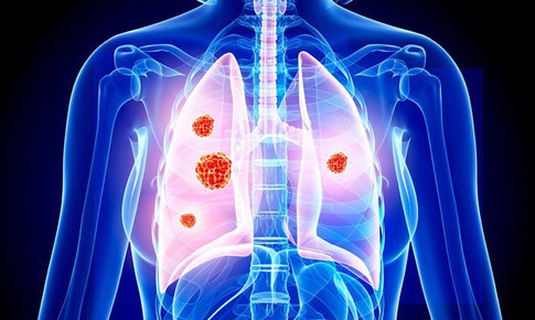 Điều trị ung thư phổi kh&#244;ng tế b&#224;o nhỏ bằng liệu ph&#225;p miễn dịch