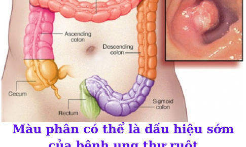 Thay đổi thói quen đi đại tiện có thể là dấu hiệu cảnh báo bệnh ung thư ruột