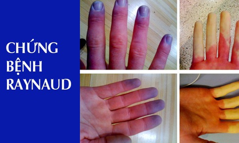 Trời lạnh, ng&#243;n tay đau buốt, chuyển m&#224;u đỏ, t&#237;m - cảnh gi&#225;c hội chứng Raynaud