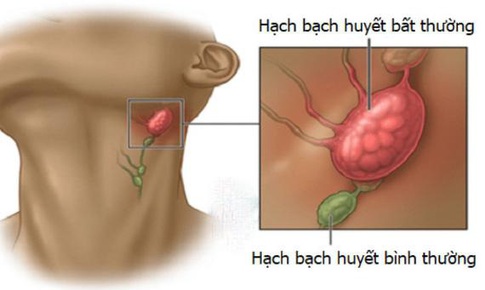 Tăng nguy cơ tử vong ở người ung thư hạch bạch huyết khi d&#249;ng ukoniq