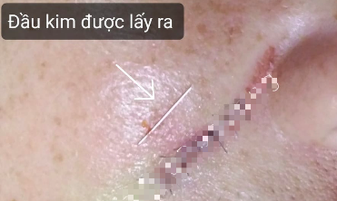 G&#227;y kim khi đang ti&#234;m filler xo&#225; r&#227;nh mũi m&#225; ở tiệm t&#243;c