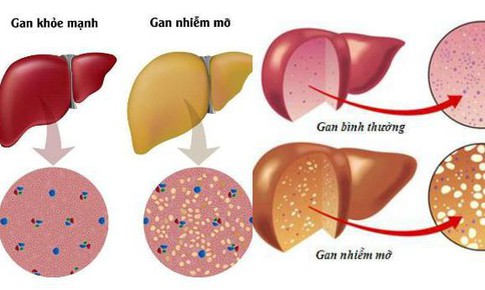 C&#225;ch ngăn ngừa gan nhiễm mỡ ở người bệnh đ&#225;i th&#225;o đường