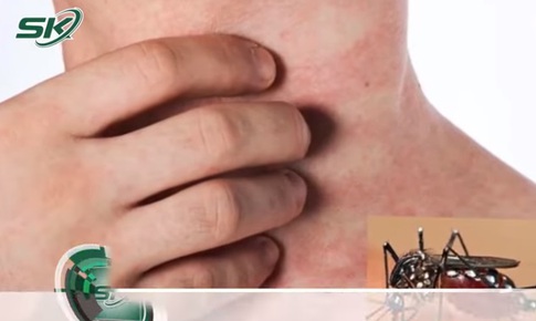 Lý giải nguyên nhân sốt xuất huyết đổ dồn về TP. HCM