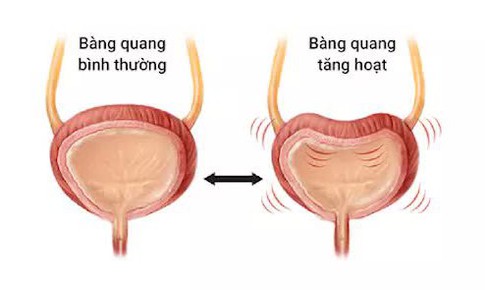 B&#224;ng quang tăng hoạt: chứng bệnh kh&#244;ng chỉ g&#226;y phiền to&#225;i