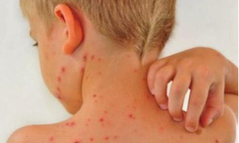 Bệnh chốc ở trẻ và những nhầm tưởng cha mẹ hay gặp