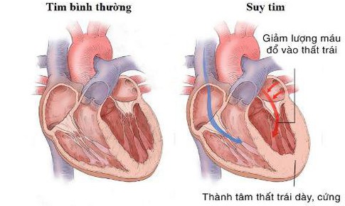 Lối sống lành mạnh giúp ngăn ngừa suy tim