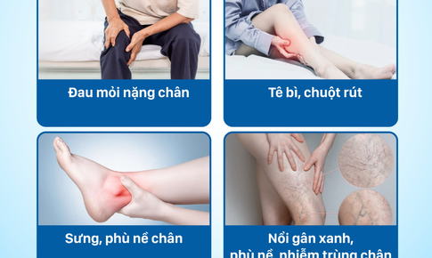 Suy gi&#227;n tĩnh mạch ch&#226;n c&#243; chữa khỏi được kh&#244;ng, ai c&#243; nguy cơ cao mắc bệnh?