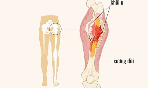 Dấu hiệu cảnh b&#225;o ung thư xương ở trẻ cha mẹ cần lưu &#253;