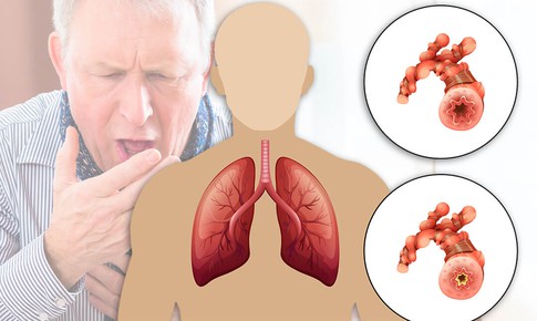 Bệnh phổi tắc nghẽn mạn t&#237;nh (COPD): N&#243;ng lạnh đan xen dễ b&#249;ng ph&#225;t c&#225;c đợt cấp của COPD