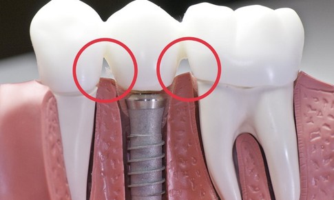 Cảnh b&#225;o t&#236;nh trạng giắt răng sau cấy gh&#233;p implant