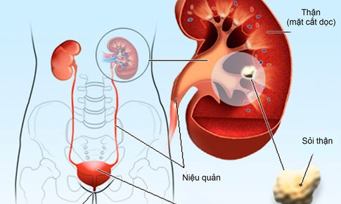 7 cơ quan trong cơ thể con người c&#243; thể tạo sỏi