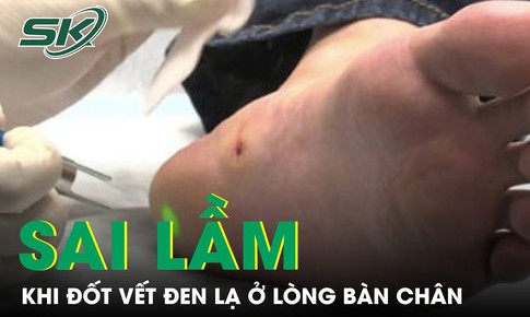 Sai lầm khi đốt vết đen lạ ở l&#242;ng b&#224;n ch&#226;n