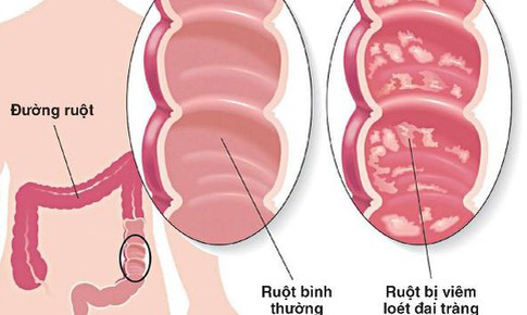 Thuốc mới điều trị viêm loét đại tràng