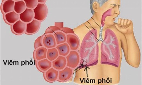 Mẹo kiểm so&#225;t bệnh vi&#234;m phổi m&#249;a đ&#244;ng