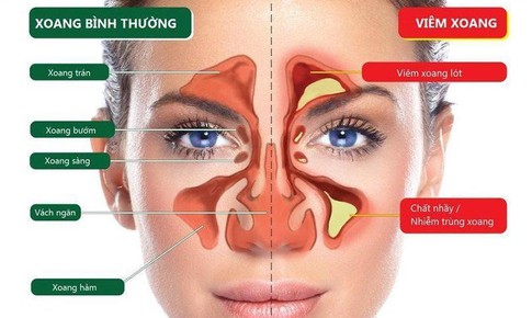 10 loại cao dược liệu qu&#253; hỗ trợ giảm c&#225;c triệu chứng vi&#234;m xoang