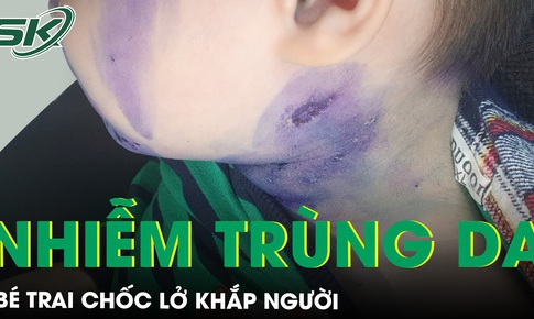 Nổi mụn nước b&#233; trai nhiễm tr&#249;ng da chốc lở khắp người