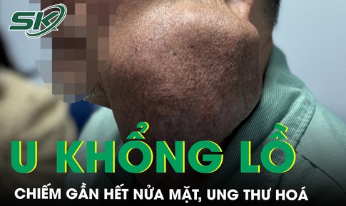 Nghĩ u l&#224;nh kh&#244;ng đi kh&#225;m, 30 năm sau khối u hoại tử, cho&#225;n hết mặt