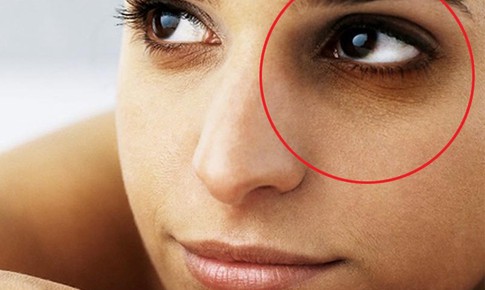 C&#225;ch loại bỏ quầng th&#226;m dưới mắt