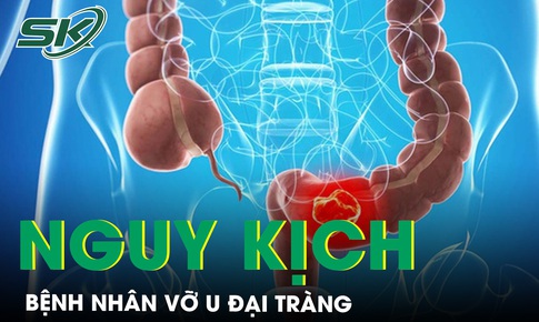 Bụng chướng nhiều, đau dữ dội v&#224;o viện ph&#225;t hiện vỡ u đại tr&#224;ng