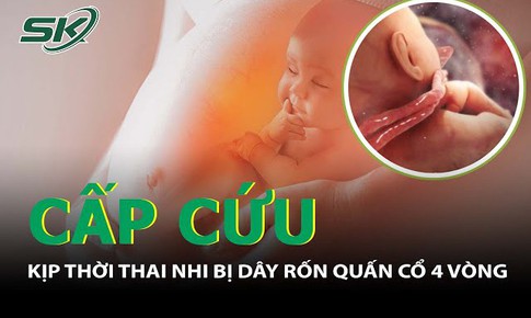 Kịp thời mổ cấp cứu thai nhi bị d&#226;y rốn quấn cổ 4 v&#242;ng