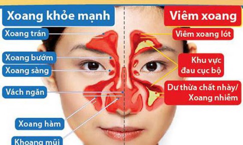 B&#224;i thuốc hỗ trợ điều trị vi&#234;m xoang