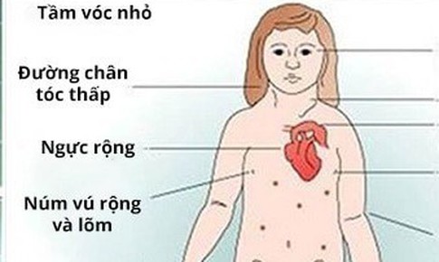 Trẻ ăn m&#227;i kh&#244;ng lớn, cảnh gi&#225;c với Hội chứng Turner