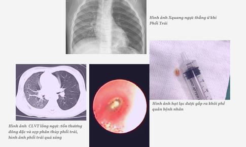 Nghệ An: Cứu sống trẻ mắc dị vật đường thở